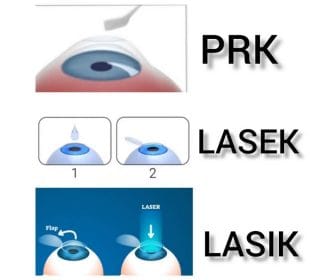 تفاوت های عمل لیزیک و لازک و PRK چیست؟