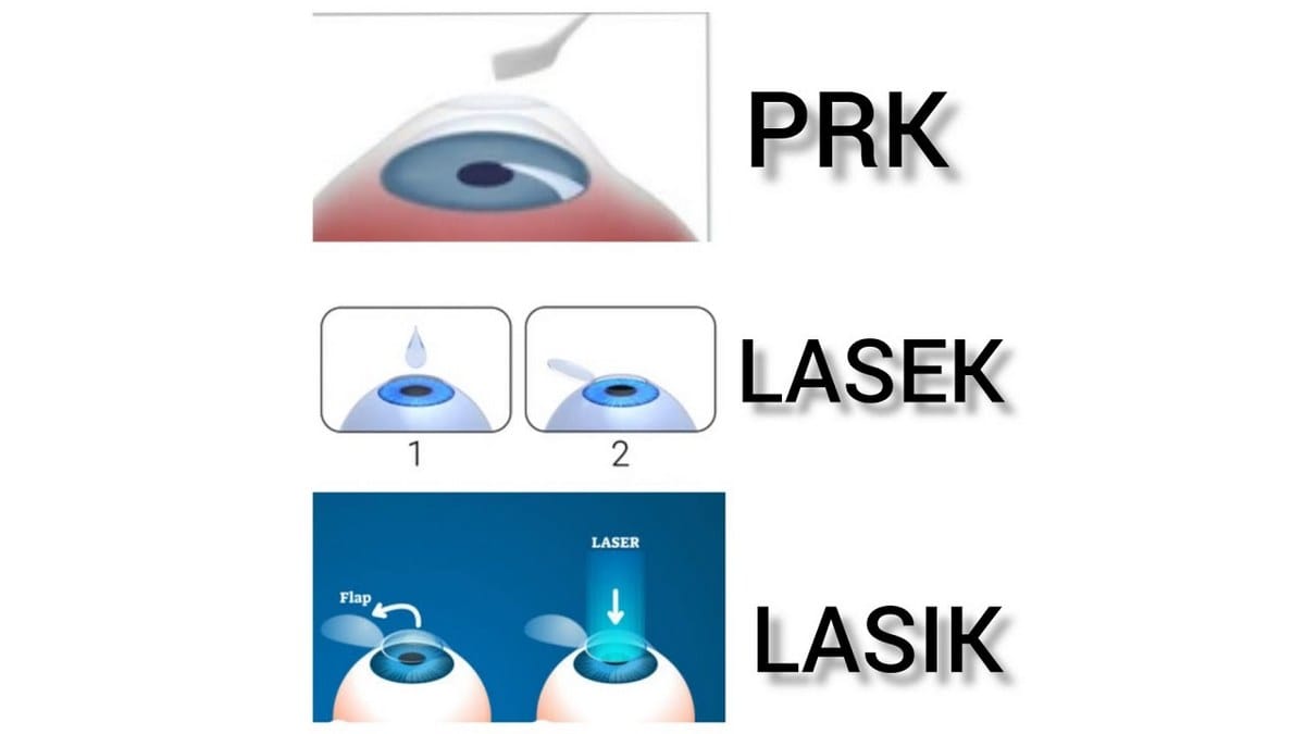 تفاوت های عمل لیزیک و لازک و PRK